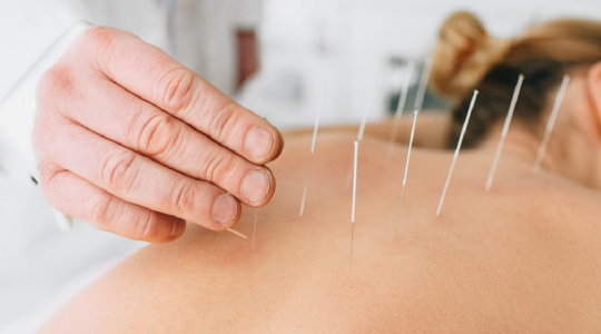 Dry Needling 3